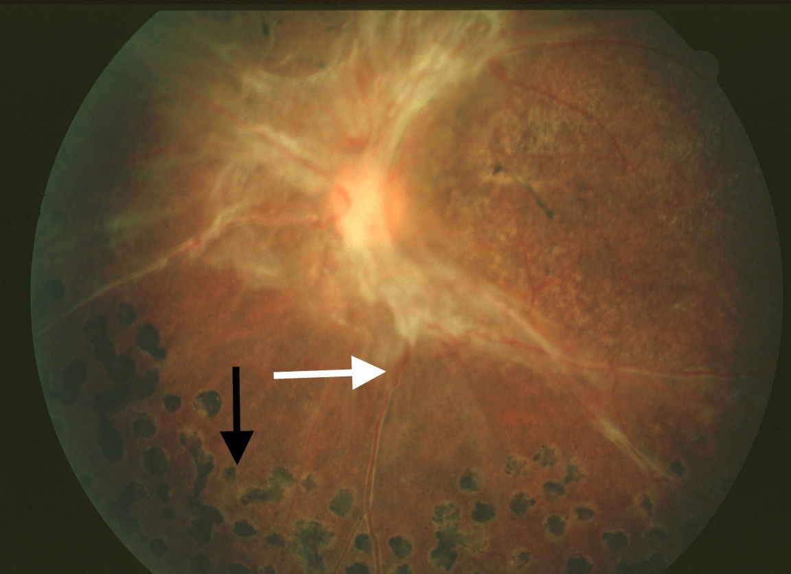 Retinal Detachment Causes Bishery